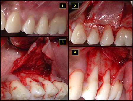 types of bone grafts in dentistry pdf